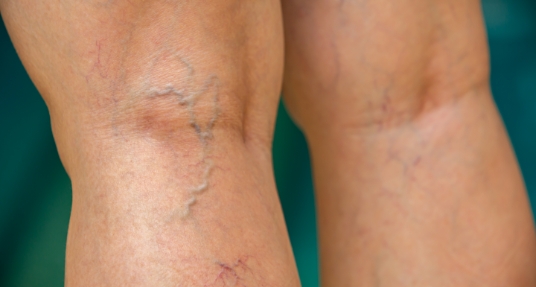 Spider Veins green bkgd