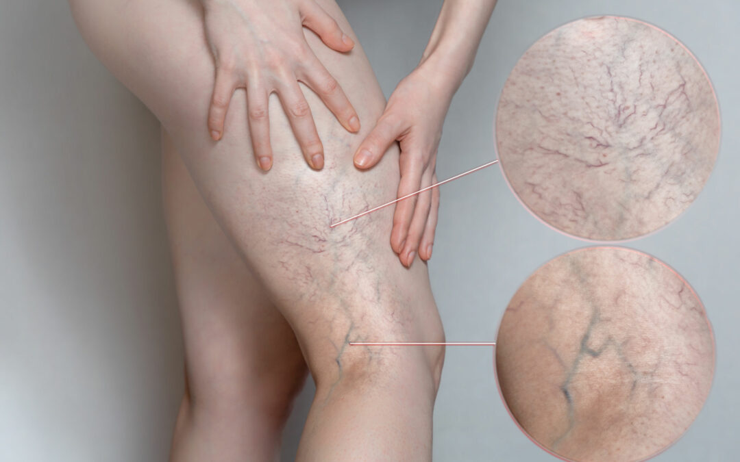 What is venous insufficiency