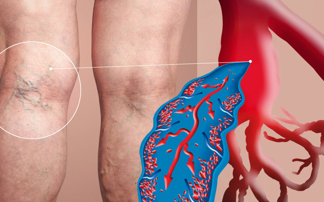 What Is The Best Treatment For Varicose Veins