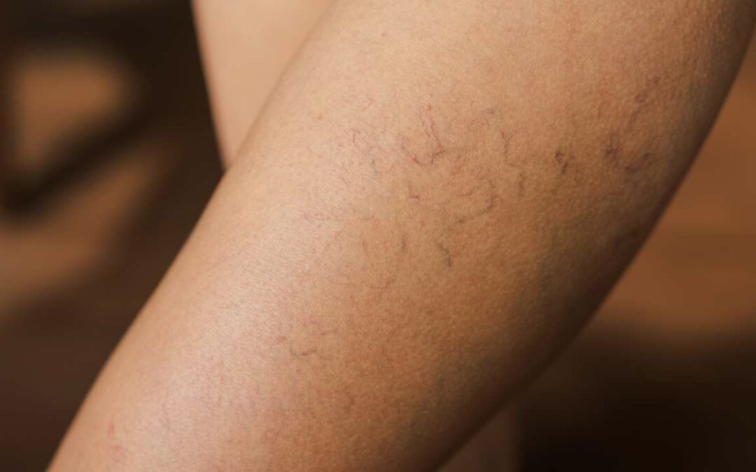 Veins: The Key to Healthy Circulation and Treatment Options