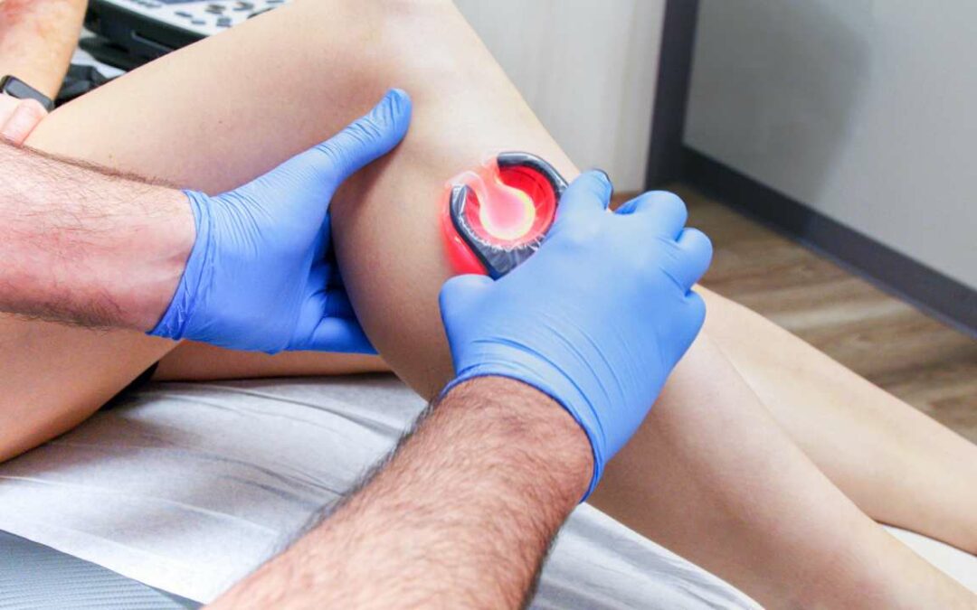 Comprehensive Guide to Varicose Vein Treatments