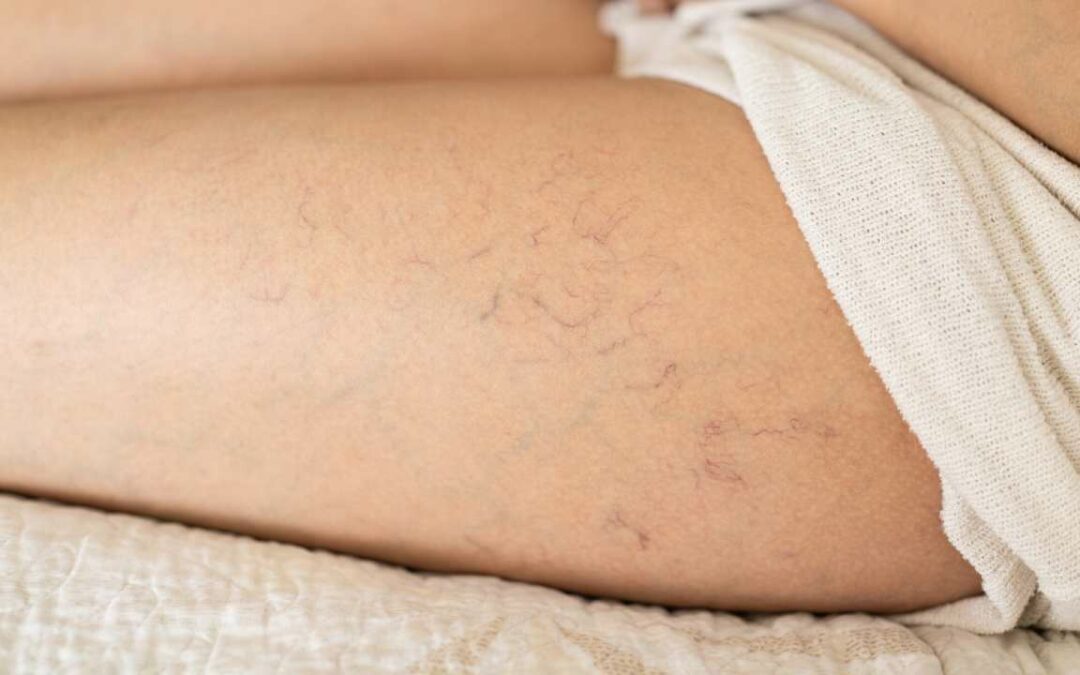 What Causes Spider Veins? These Are the Reasons!