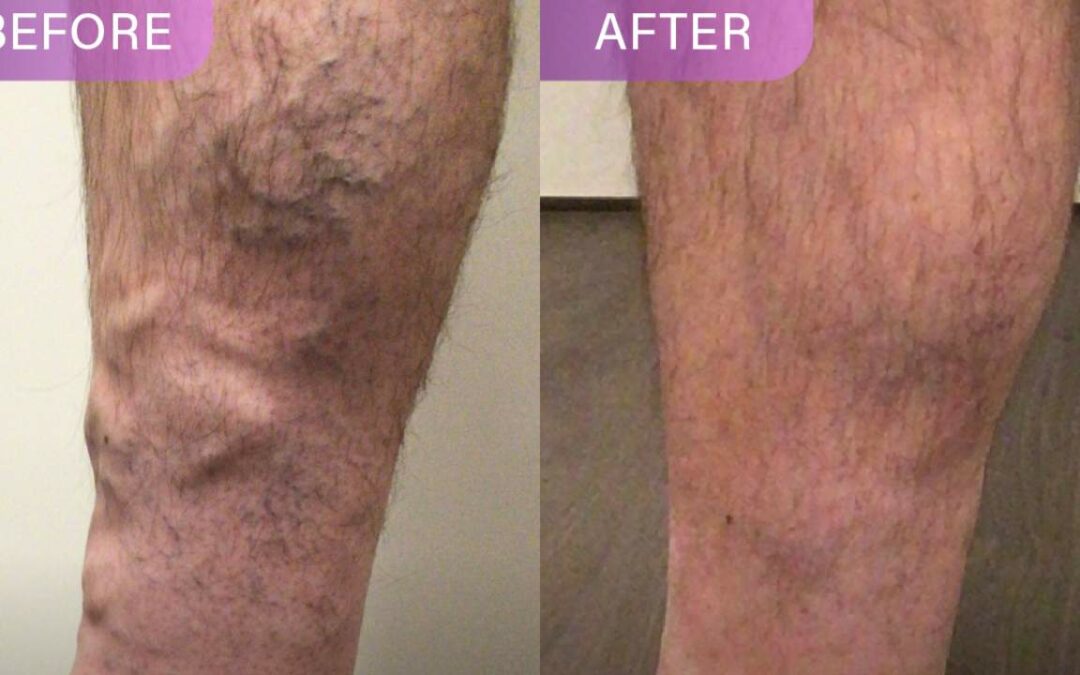 Looking for Varicose Veins Surgery? Try These Treatments