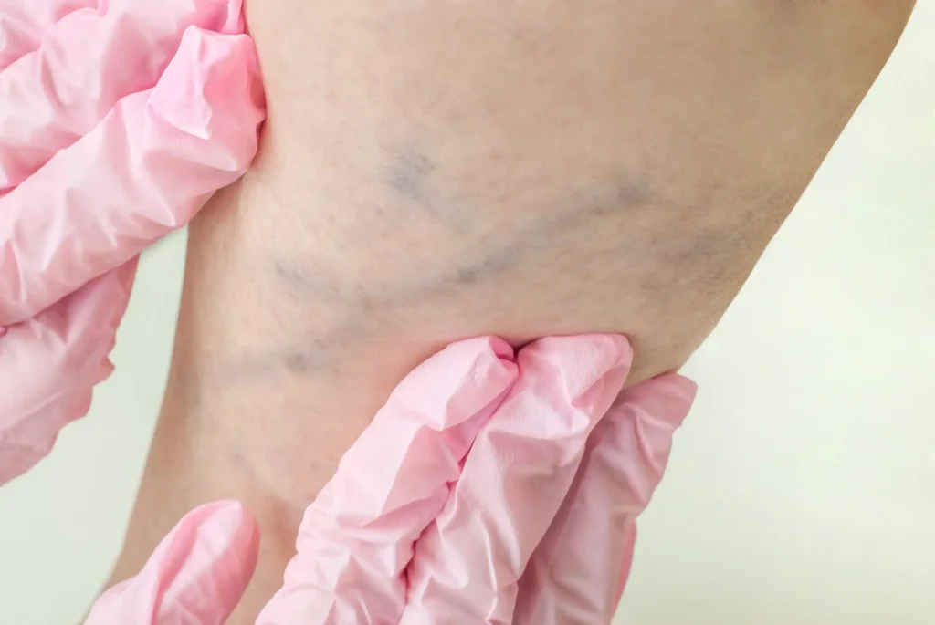 Find the best varicose vein treatment in Cedar Park, TX