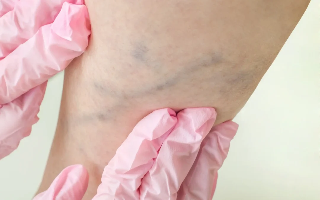 Find the best varicose vein treatment in Cedar Park, TX