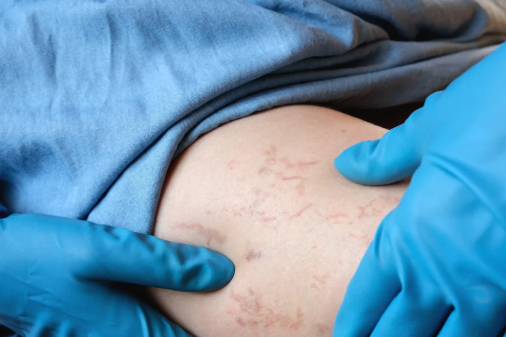 Find the best chronic venous insufficiency treatment for varicose veins in Cedar Park, TX