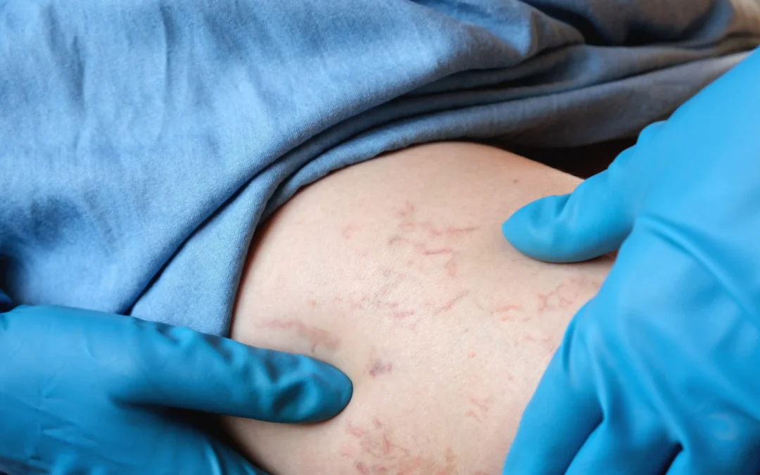 Find the best chronic venous insufficiency treatment for varicose veins in Cedar Park, TX