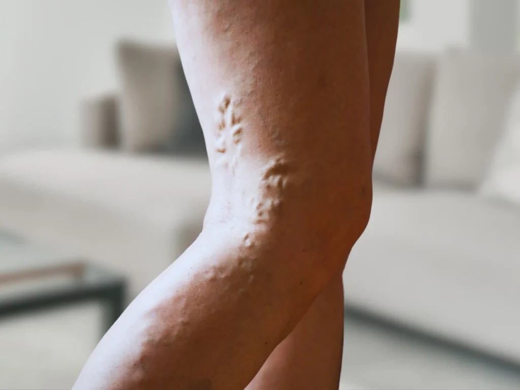 Say goodbye to varicose veins in Cedar Park, TX