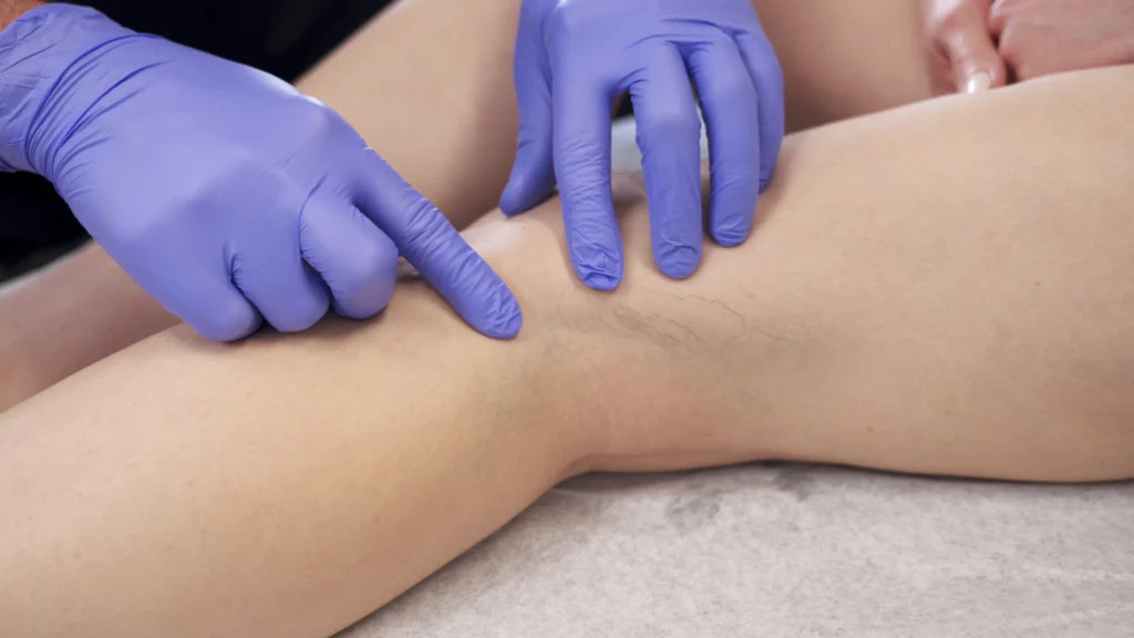 Where Can I Find Insurance-Covered Vein Treatments in Arlington, Texas?