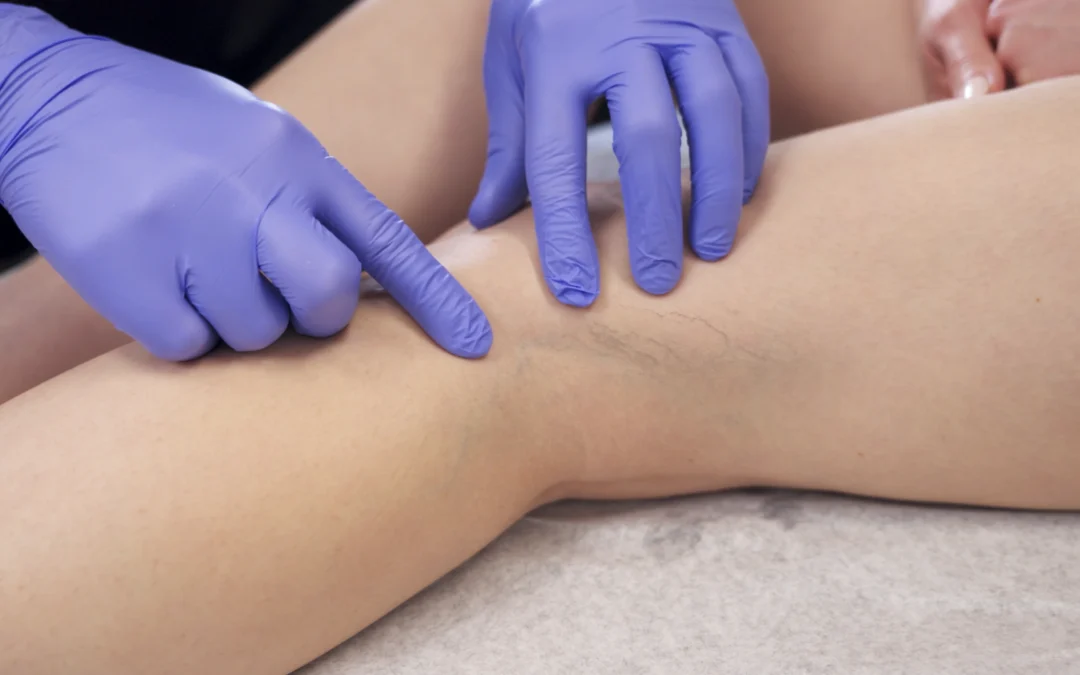 Where Can I Find Insurance-Covered Vein Treatments in Arlington, Texas?